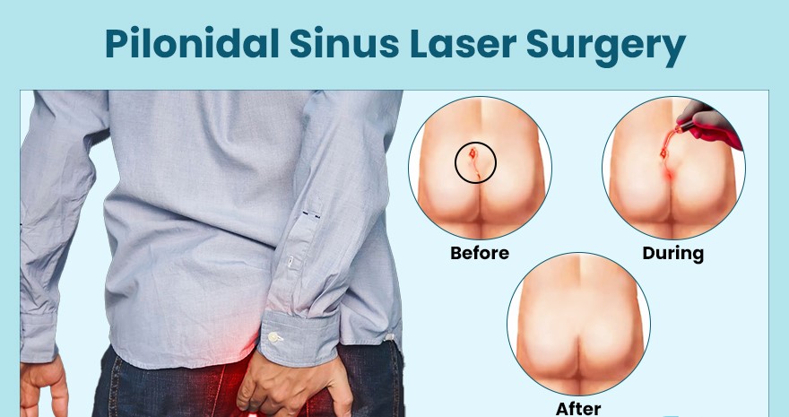 Pilonidal Sinus Laser Surgery - Procedure, Benefits, Recovery
